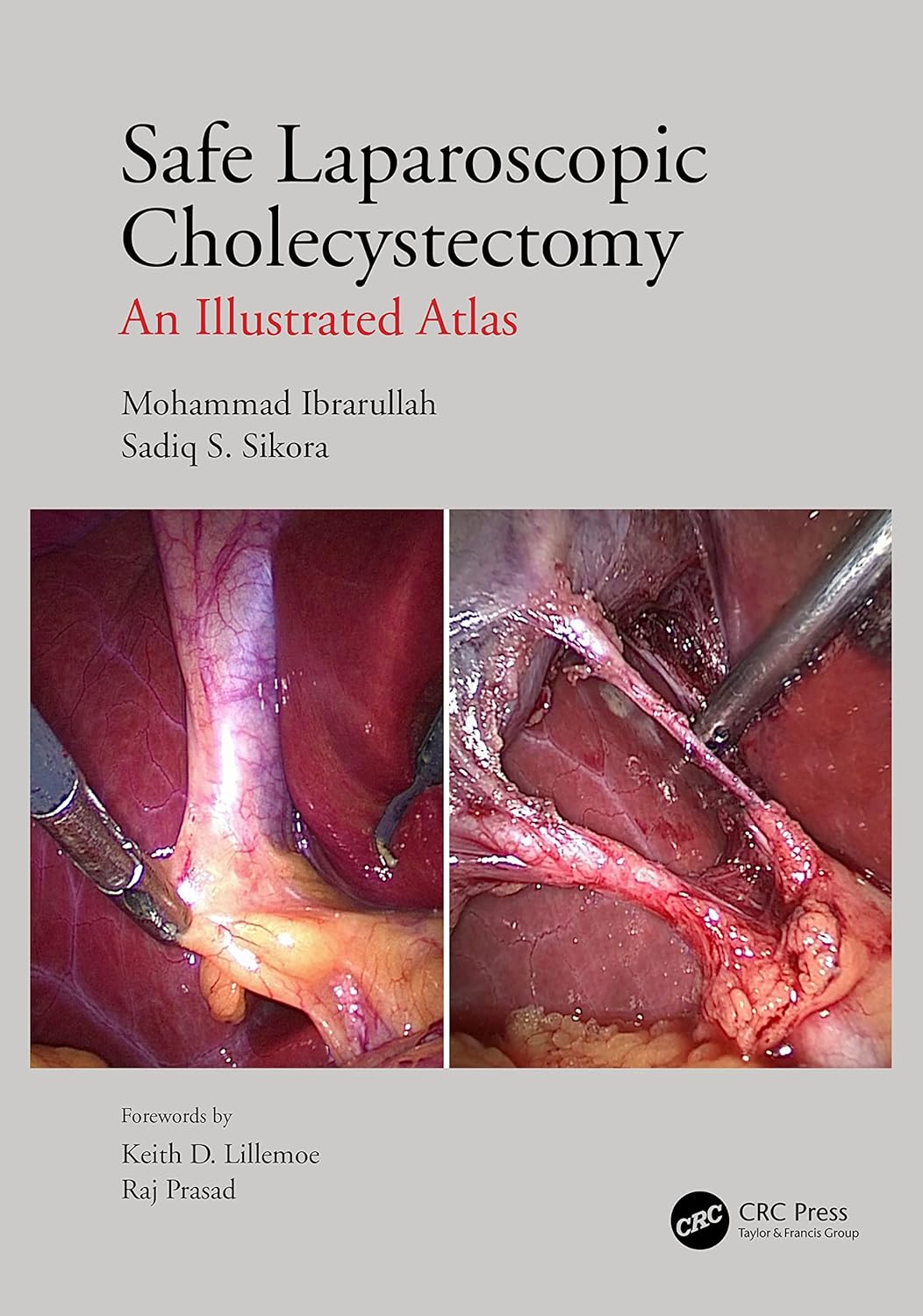 Buy Safe Laparoscopic Cholecystectomy: An Illustrated Atlas (English, Kindle Edition, Mohammad Ibrarullah, Sadiq S Sikora) Online at Best Price - BookBajar