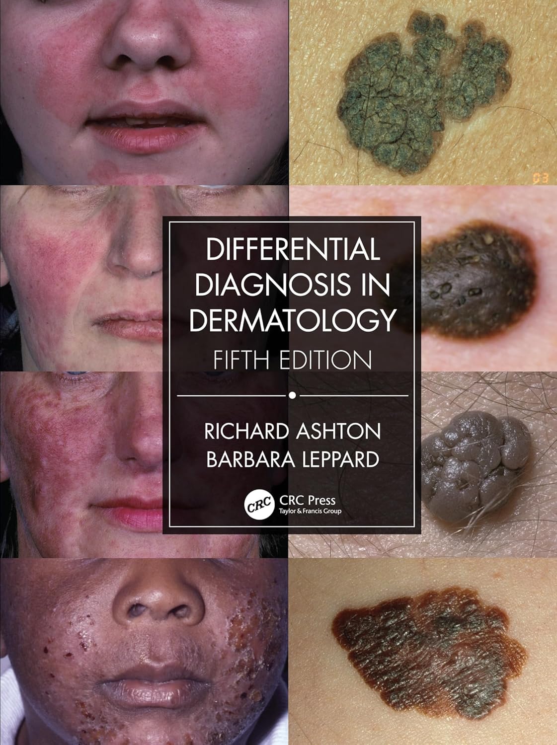 Buy Differential Diagnosis in Dermatology (English, Hardcover, Richard Ashton, Barbara Leppard) Online at Best Price - BookBajar