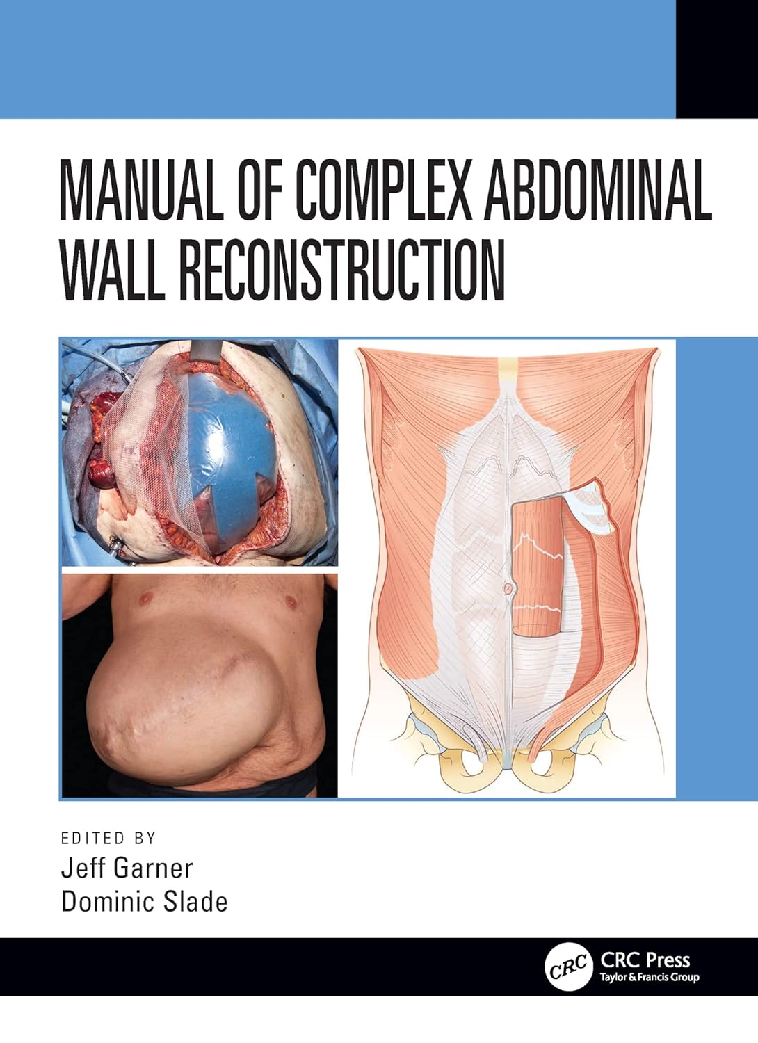 Buy Manual of Complex Abdominal Wall Reconstruction (English, Kindle Edition, Jeff Garner, Dominic Slade) Online at Best Price - BookBajar