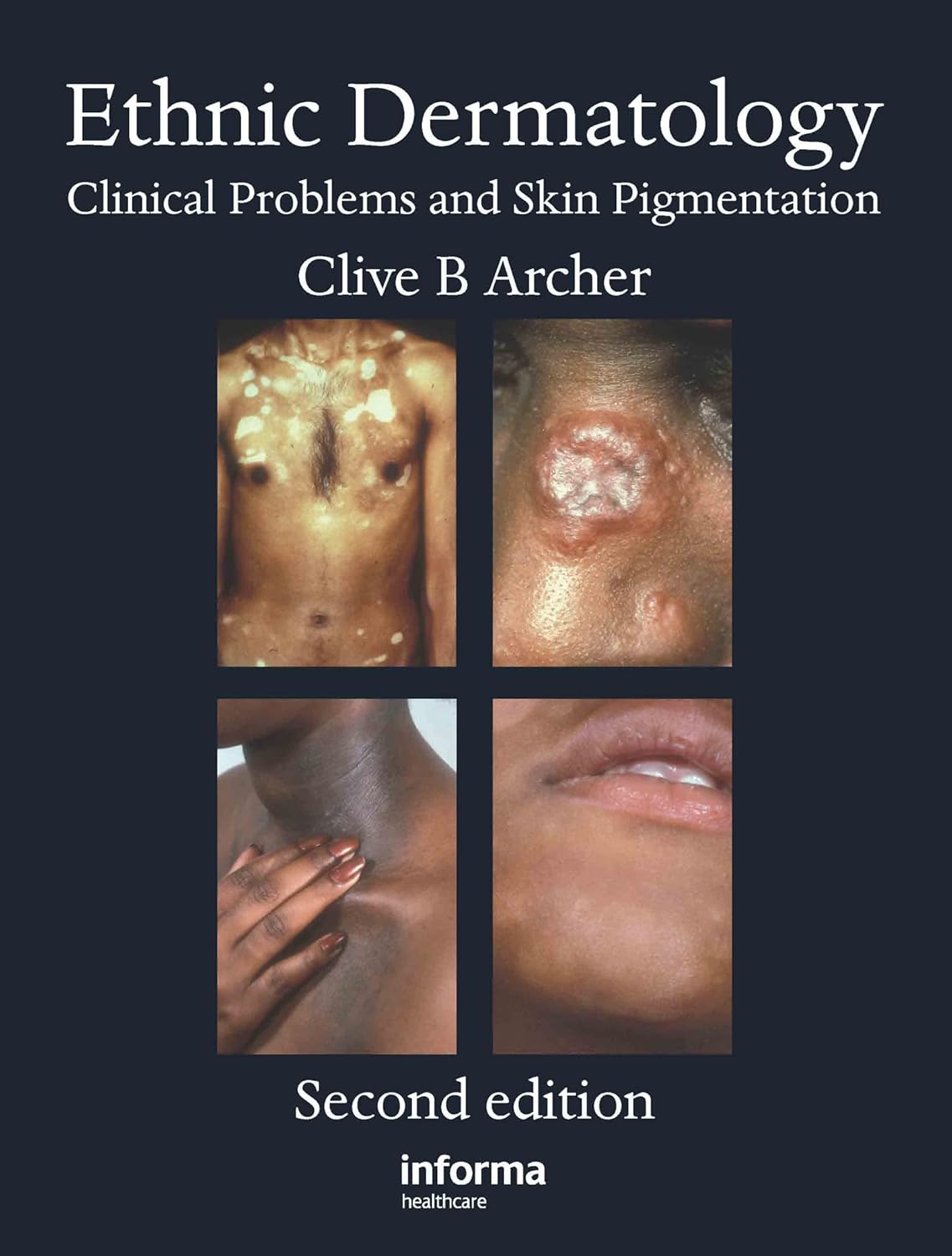 Buy Ethnic Dermatology: Clinical Problems and Skin Pigmentation (English, Kindle Edition, Clive B. Archer) Online at Best Price - BookBajar