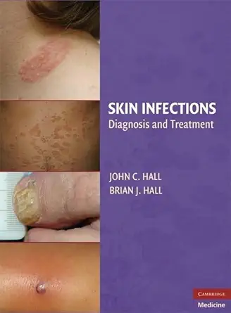 Buy Skin Infections: Diagnosis and Treatment (English, Kindle Edition, John C. Hall MD, Brian J. Hall) Online at Best Price - BookBajar