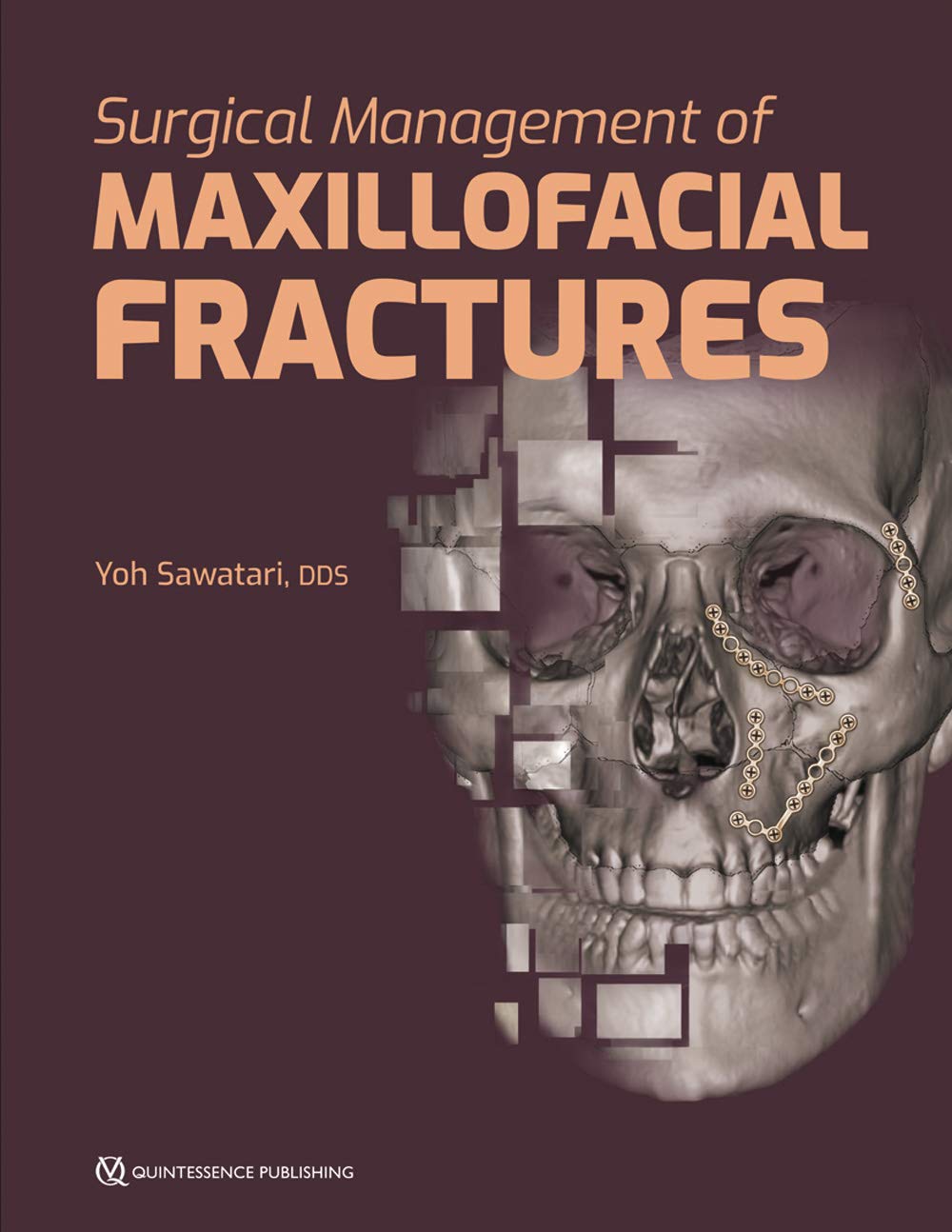 Buy Surgical Management OF Maxillofacial Fractures (HB 2019) (English, Paperback, Sawatari Y.) Online at Best Price - BookBajar
