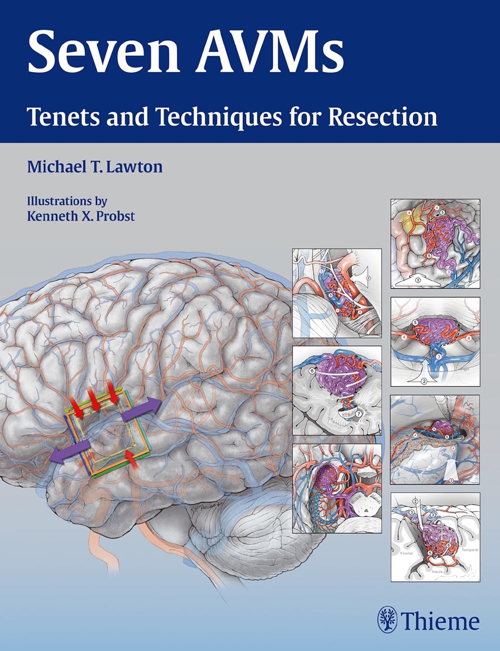 Seven AVMs: Tenets and Techniques for Resection (English, Paperback, Michael T. Lawton) - Image 1 - BookBajar