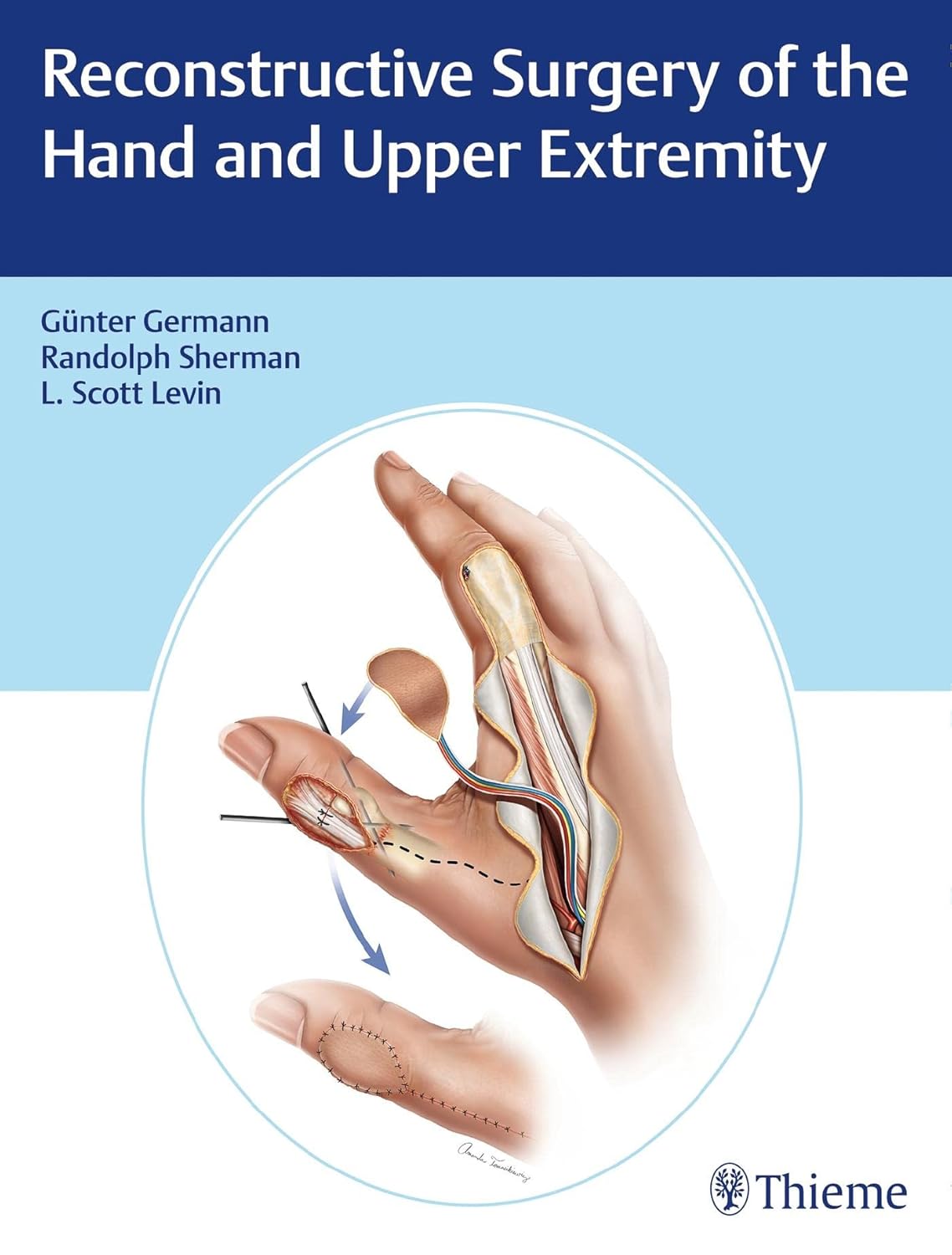 Buy Reconstructive Surgery of the Hand and Upper Extremity (English, Paperback, Gunter Germann, L.Scott Levin, Randolph Sherman) Online at Best Price - BookBajar