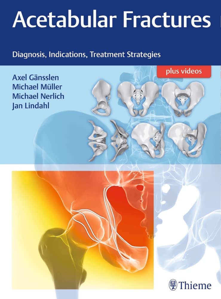Buy Acetabular Fractures: Diagnosis, Indications, Treatment Strategies (English, Paperback, Axel Gänsslen, Michael Müller, Michael Nerlich, Jan Lindahl) Online at Best Price - BookBajar
