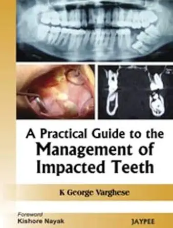 Buy A Practical Guide to the Management of Impacted Teeth (English, Paperback, George Varghese) Online at Best Price - BookBajar