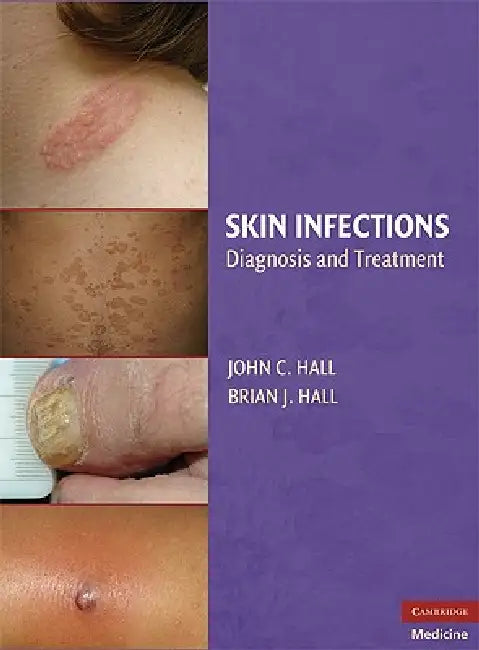 Buy Skin Infections (English, John C. Hall | Brian J. Hall) Online at Best Price - BookBajar